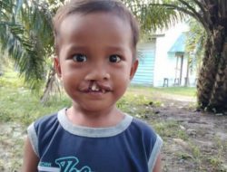 Nahum Sinaga, Bisa Tersenyum Seperti Anak Lainnya, Berkat Operasi Bibir Sumbing Bantuan IPTU Suheri Sitorus